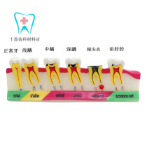 Dental Oral Teaching Caries Classification Model Teeth Caries Bad Lesion Lesion Demonstration Explaining Doctor-patient Communication