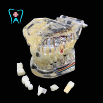 Dental Oral Teaching Model Adult Crystal Pathology Repair Model With Tooth Nerve Removable Tooth
