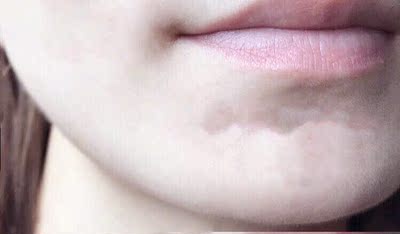 效果还可以,一直在用这款。一个疗程用在腋下,嘴唇,黑色素淡化了,皮肤都变粉嫩粉嫩的,不油腻不过敏。又回购一疗用在下面,大腿内侧,黑黑的自己看着都不舒服。 效果还可以,一直在用这款。一个疗程用在腋下,嘴唇,黑色素淡化了,皮肤都变粉嫩粉嫩的,不油腻不过敏。又回购一疗用在下面,大腿内侧,黑黑的自己看着都不舒服。