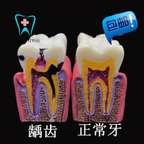 Dental Oral Teaching Model 6 Times Carious Teeth Contrast Model Doctor-patient Communication Tooth Lesion Contrast