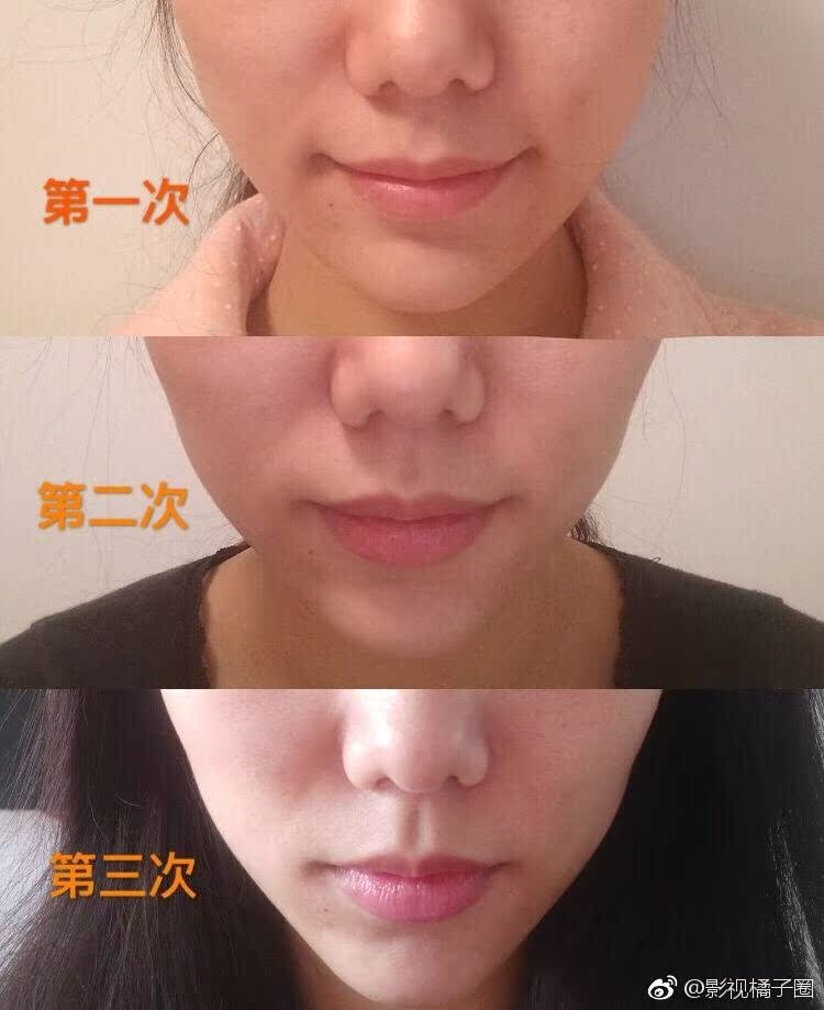 tripollarpink电子美容仪