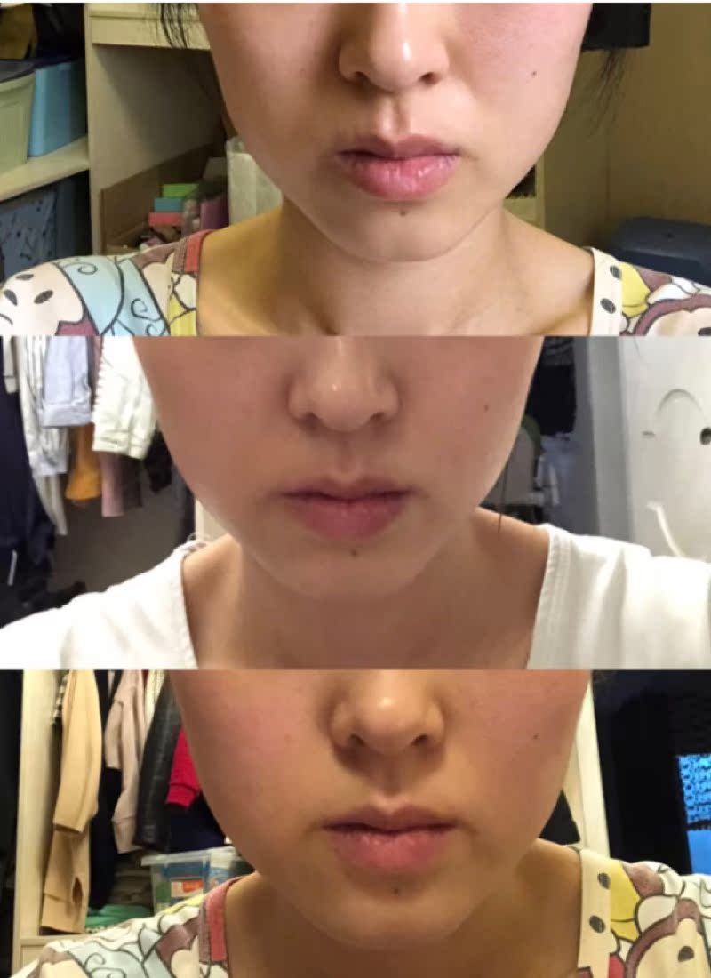 tripollarpink电子美容仪