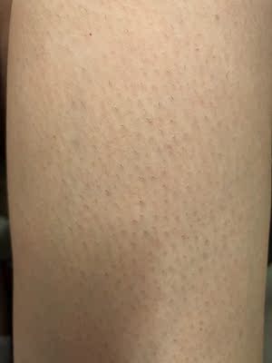 买到现在大约也用了五六天，给手臂做过两次，大约是三天一次，长得挺慢的，到现在为止也只长了两厘米，小腿上的会长得快一点，之前也是种草很久，因为看到评价说机器特别慢，根本没有耐心做下去，一直也挺担心买来没时间用的，现在觉得还好啦，其实没有他们评价的那么慢，我一般没课的时候看电视剧的时候做没觉得不耐烦，还是可以坚持的，希望坚持下去有用，会给大家继续测评的，如果有效果会给小仙女们追加的。