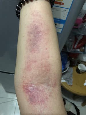 拿到手就回家试用了，吸的挺紧的，当走罐使用，身体筋络不通的地方真的很疼，出痧也很快。在家就可以自己输通经络了当然前提是能忍住疼。缺点就是热量和负压力只能往高调不能往低调，想调低只能重启动。