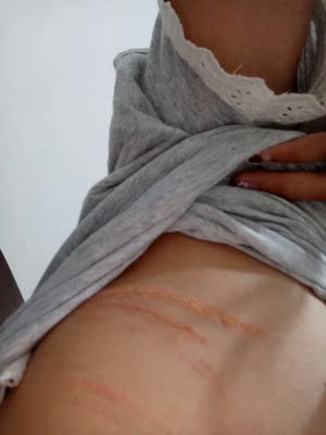 内衣那都好，显胸小，不聚拢是我喜欢的，但是太伤害皮肤了，只穿了两天就磨成这样，而且还痒的难受，穿这个内衣简直跟受罪一样