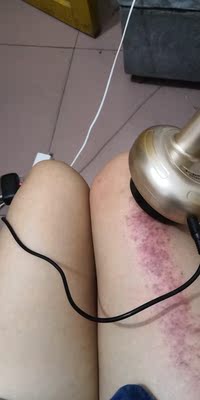 东西今天收到的，迫不及待用了，效果很好，可能是我不受力，感觉吸力好大啊，已经调到最小了吸的我还是痛，出了很多的痧气，做完了腿挺舒服，下次叫我老公给我做背，坚决支持，真的不错呢，价格也实惠，南极人的忠实拥护者，我可不是托