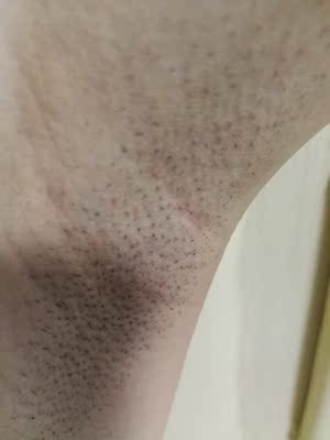 脱毛效果还不错