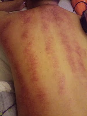 有了这个以后刮痧就太方便了, 平时本来也爱的按摩店去刮痧和拔罐的,这下可以沈河了好多钱,这机子各方面都非常的满意, 出痧非常快, 只不过感觉高痛了,比街上拿手刮的都还要痛。 有了这个以后刮痧就太方便了, 平时本来也爱的按摩店去刮痧和拔罐的,这下可以沈河了好多钱,这机子各方面都非常的满意, 出痧非常快, 只不过感觉高痛了,比街上拿手刮的都还要痛。