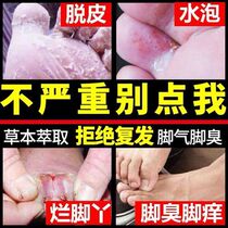 Athletes foot removes the root artifact to relieve itching peeling and sterilization liquid to remove foot odor and rotten feet.