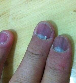 肝脏不好的人,手指甲会有什么不一样?