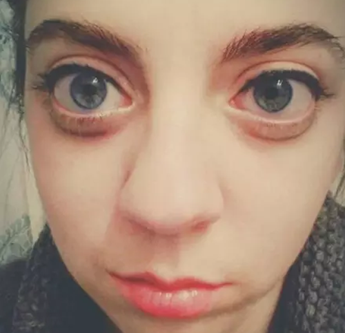 但是她说感觉自己的眼睛跟肿了一样,怪怪的!