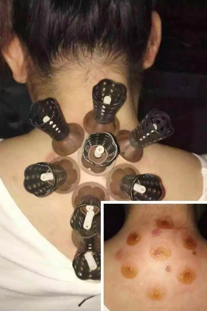 过敏性湿疹 选大椎,肺俞,膈俞,肾俞,在膀胱经上找到这些穴位进行拔罐