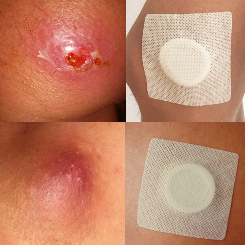 拔毒膏拔毒贴火疖子坐板疮拔脓膏皮脂腺囊肿祛痘贴膏药粉正品