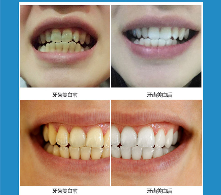 牙斑净牙齿美白白牙素美牙去黄牙烟渍牙黑牙渍洗牙水漂白洁白
