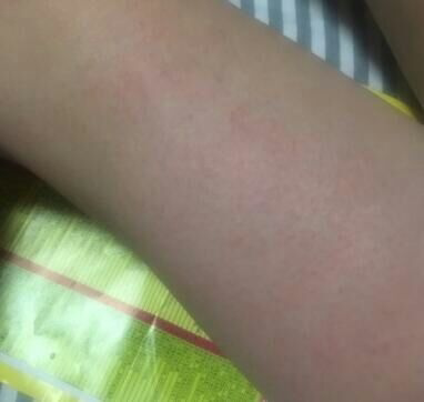 确实有起到淡化的作用了呢，之前和现在比完全都不一样了，喜欢这款宝贝，用了这么久了也没出现过敏的现象，可以可以，这瓶用完了，还会再来买的。太喜欢了。