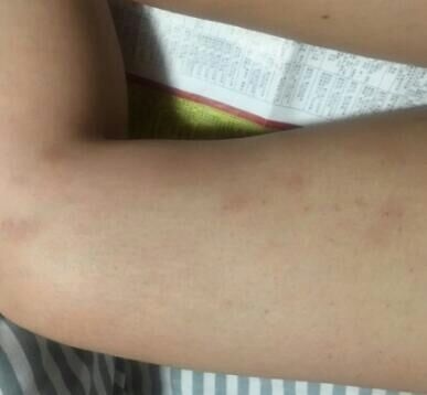 确实有起到淡化的作用了呢，之前和现在比完全都不一样了，喜欢这款宝贝，用了这么久了也没出现过敏的现象，可以可以，这瓶用完了，还会再来买的。太喜欢了。