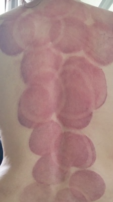 第七代效果很好。吸力特别大。客服特耐心。用于有氧拔罐一吸一放,比传统拔罐舒服。几个朋友试用后都说要跟着买一个自用。 第七代效果很好。吸力特别大。客服特耐心。用于有氧拔罐一吸一放,比传统拔罐舒服。几个朋友试用后都说要跟着买一个自用。