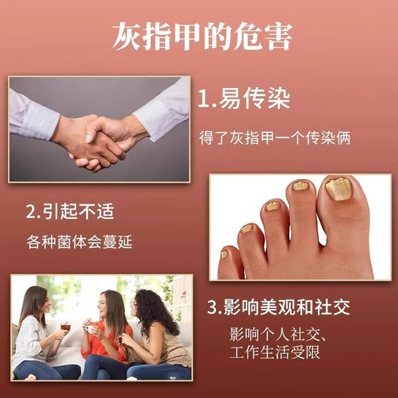 amoprofen liniment onychomycosis 정통 플래그십 스토어 아로마 펜 하이드로 클로라이드 라이먼트 크림을위한 onychomycosis special amoprofen liniment onychomycosis 정통 플래그십 스토어 아로마 펜 하이드로 클로라이드 라이먼트 크림을위한 onychomycosis special