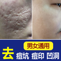 Cover Pimple Pimple pimple for flawless liquid cream to remove pimple pimple fill pit paste Hole Scar stickler Goosebumps Facial Deity