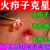 Fire boils detoxification ointment sebum acne acne adenoma gland cyst ointment paste pustules red swollen lumps hard lumps detoxification artifact