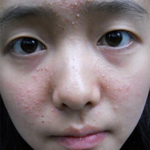 脸上长了很多小白疙瘩,到底要不要挤掉?