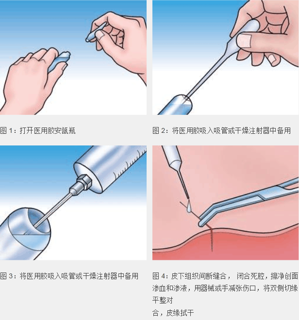 美容胶水 免缝合胶水 皮肤和皮肤粘贴 双眼皮胶水 微整胶水