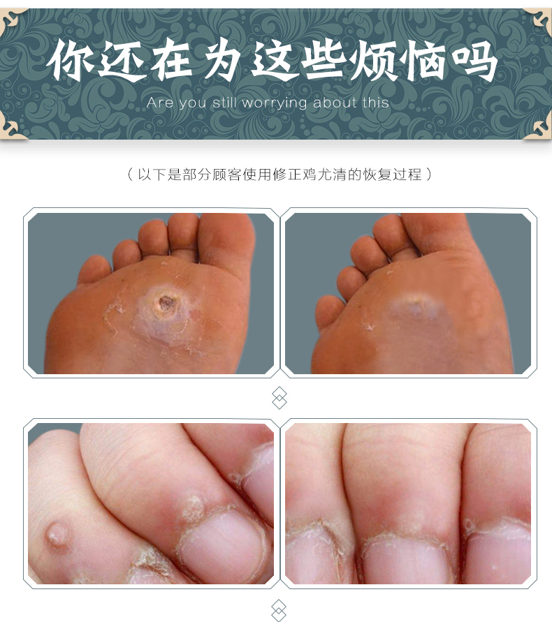 天猫【买2送1】去足刺瘊子鸡眼膏贴