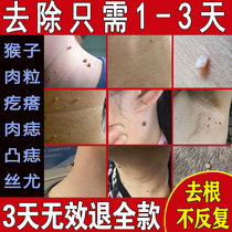 Wart wart meat particles a touch of worry-free removal of small meat particles on the neck of the monkey filamentous wart neck sarcoma removal cream