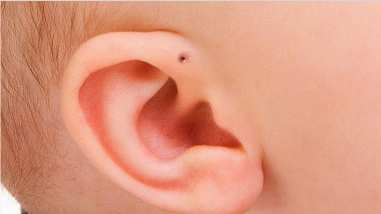 孩子耳朵上有小洞吗？如果有，千万小心了1