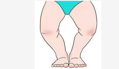 o型腿在医学上称为膝内翻,俗称"罗圈腿","弓形腿","箩筐腿".