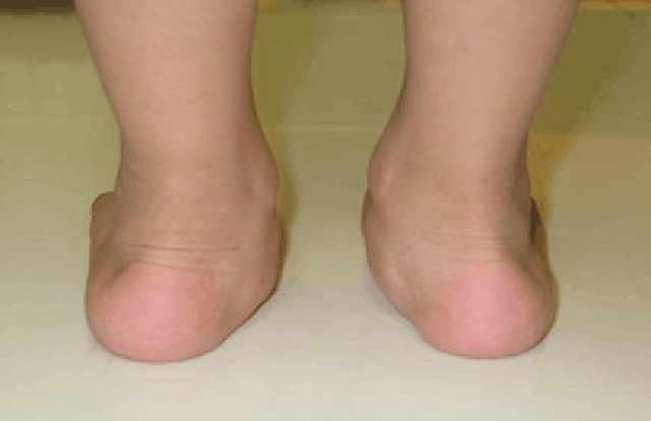 给孩子买鞋,一定要避免足弓变形的误区