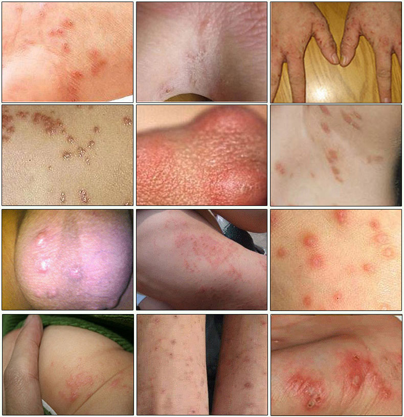 诗莱格选郎中硫磺软膏乳阴囊疥结节霜硫黄虱疥虫止痒灵一扫光瘙痒