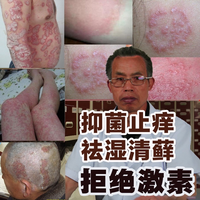 肤毒癣根净股藓癣痒灵牛皮药膏手脚皮肤瘙痒止痒特效抑菌真菌克星