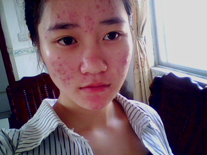 可留下痘印怎么办