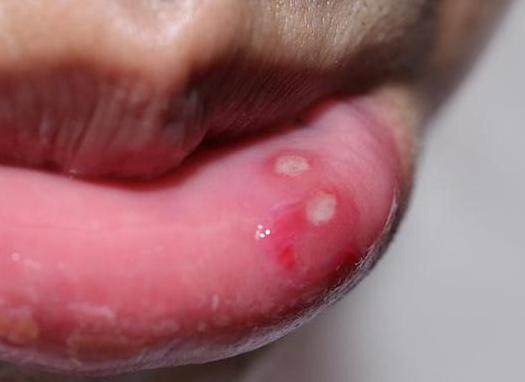 复发性口腔溃疡不简单,暗示身体有问题
