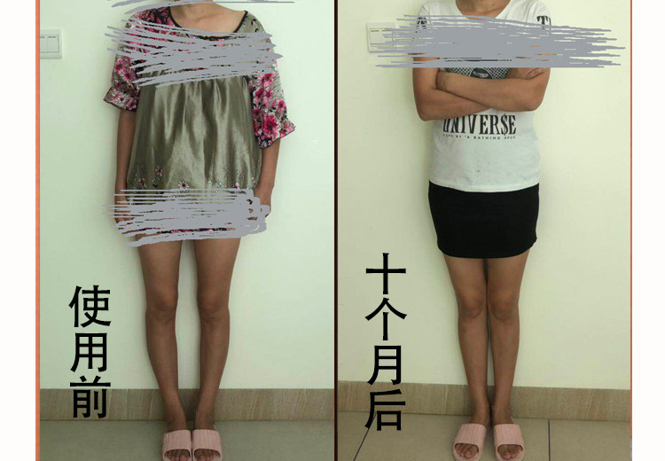 o型腿罗圈腿矫正腿型神器