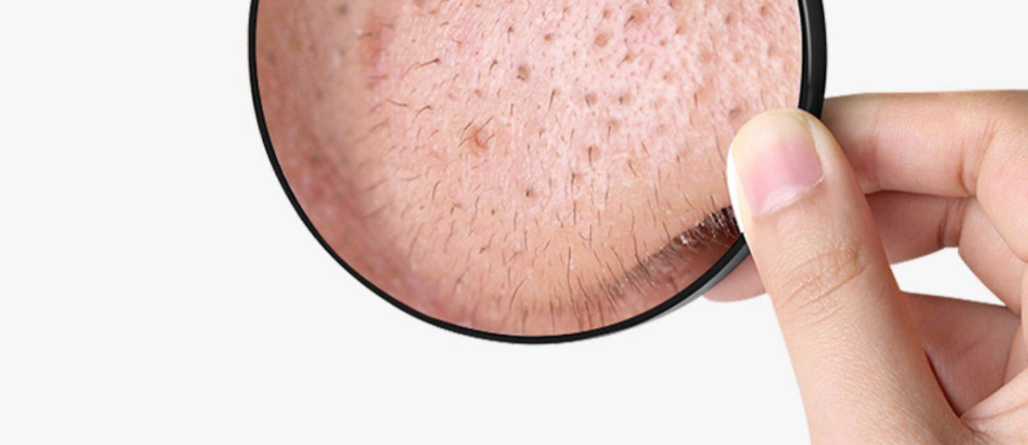 闭口粉刺针细胞夹拔去黑头神器排挑挤痘痘美容院专用镊子工具套装_淘