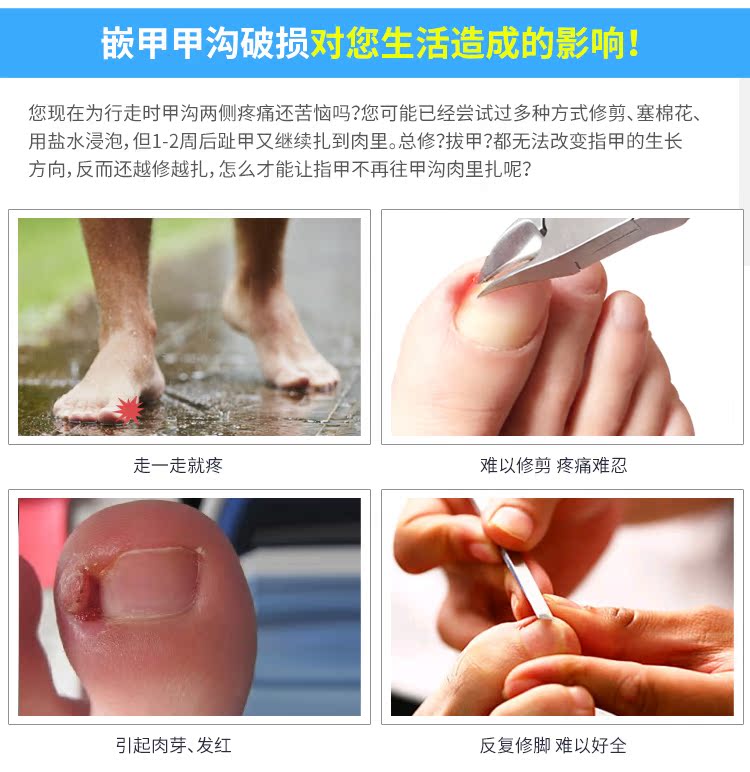 森卓正甲贴甲沟嵌甲矫正器贴片脚趾甲剪康专用指甲刀修脚套装钳炎_7折