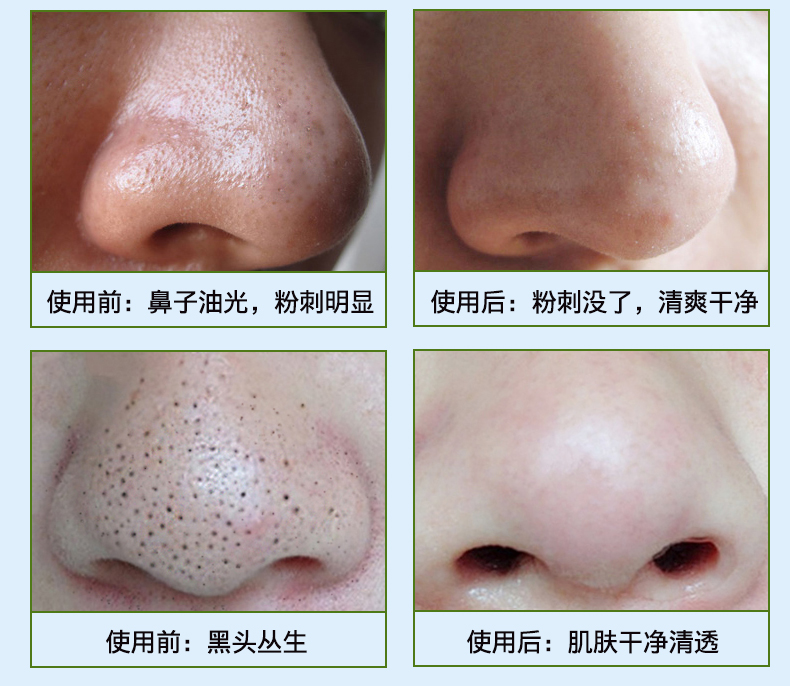 展示与对比:收缩毛孔精华液毛孔粗大修复女去黑头收敛