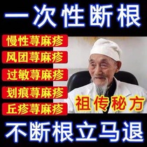 Urticaria allergies allergies antipruritics special medicines for eliminating root causes