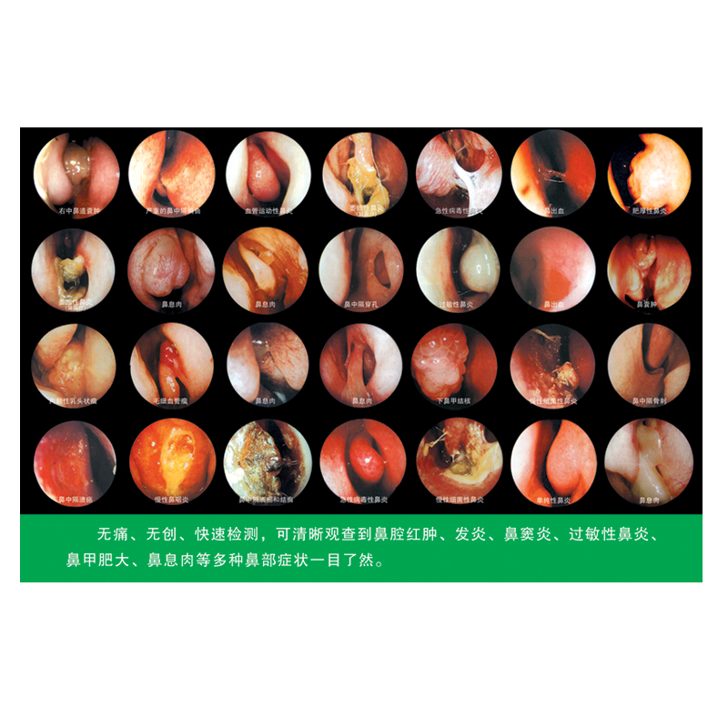 br5000影像观察仪鼻腔内窥镜教学挂图带背胶一张包邮1米5x1米