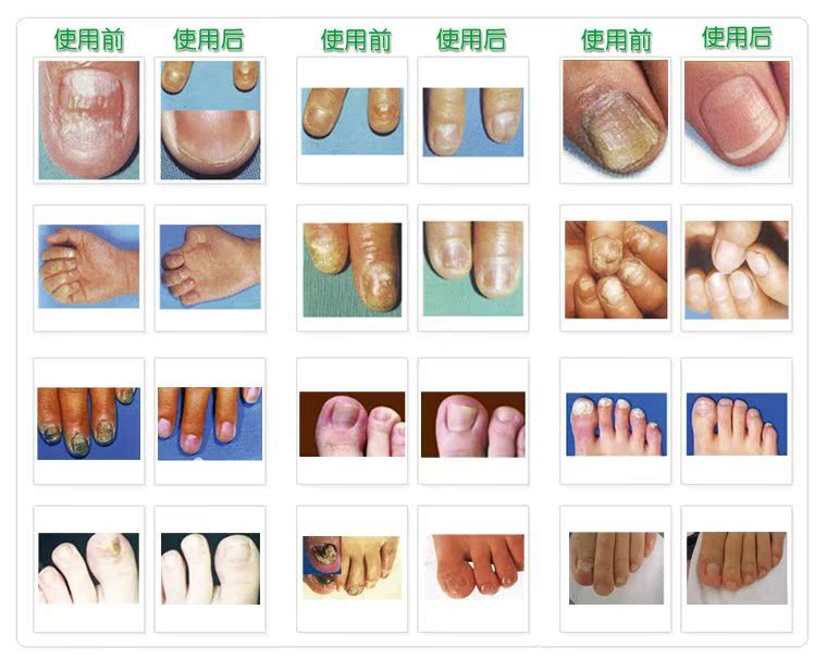 灰指甲在医保范围吗 医保治疗灰指甲