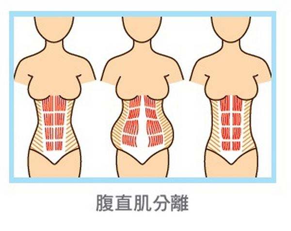 这种 产后腹直肌分离虽然不是很正常,但是也是时常发生的事情