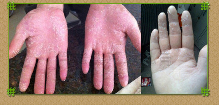 手痒水泡手癣藓药治季节性手脱皮修复霜鹅掌风手气干裂真菌止痒膏