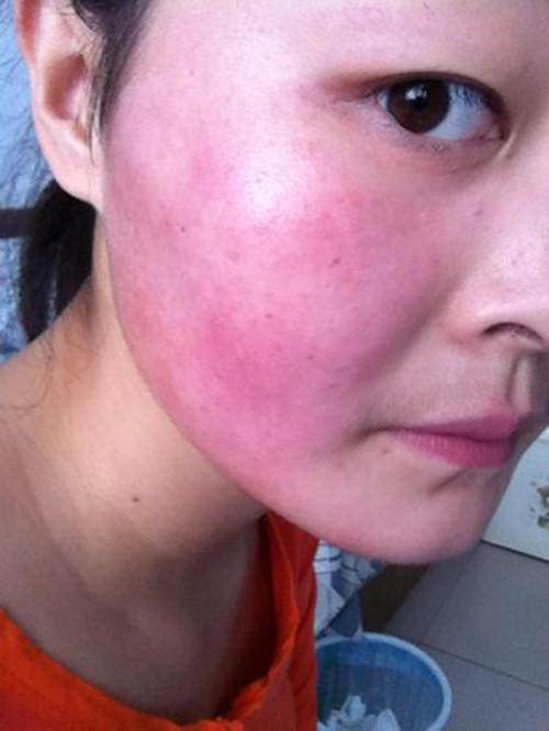 及时给皮肤降温,不仅能降低黑色素活性,减缓皮肤晒黑速度,还可以舒缓