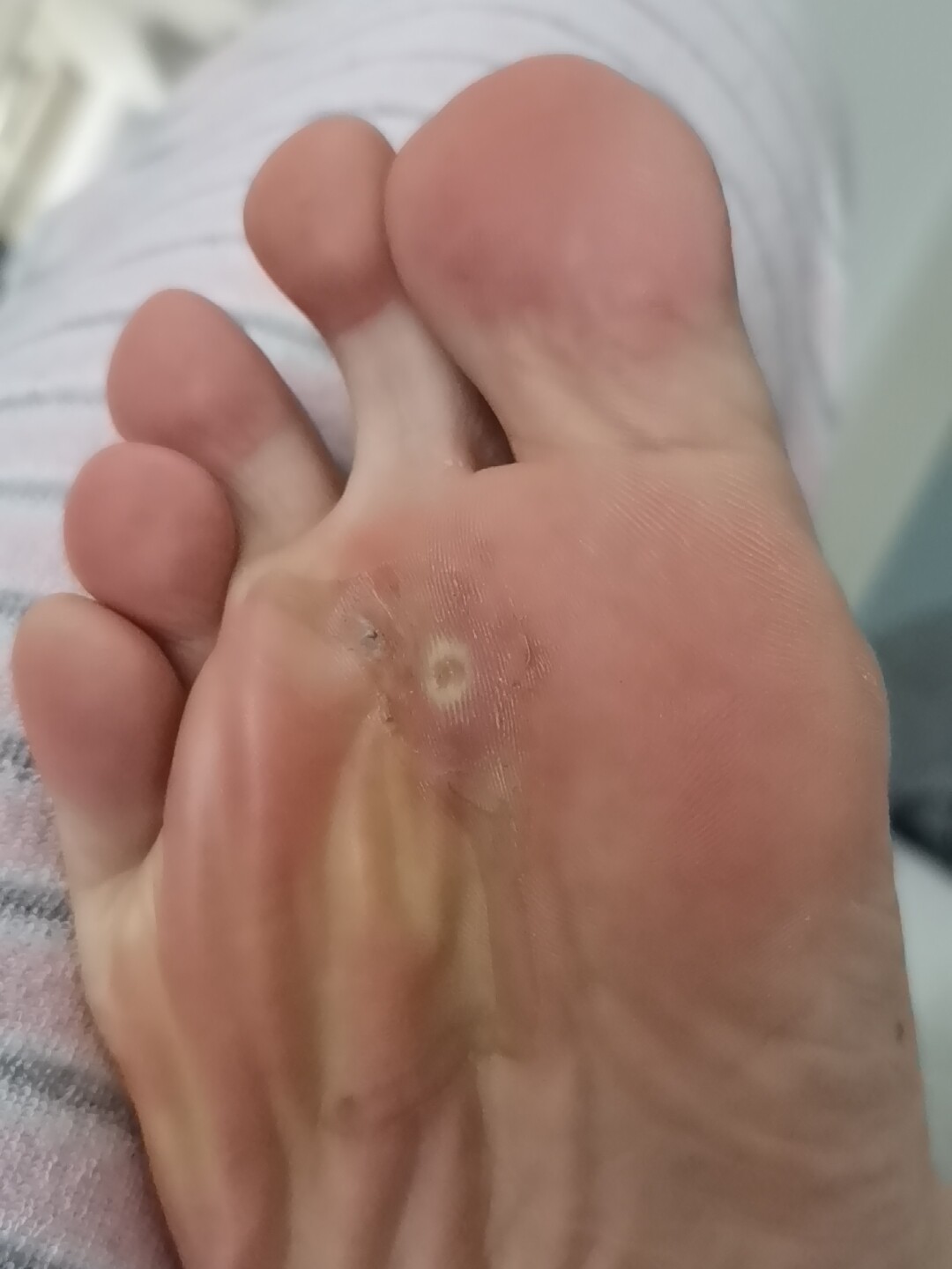 鸡眼专用膏鸡眼脚底祛脚垫脚茧厚茧鸡眼祛肉刺猴子