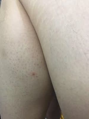 天生腿上就是毛茸茸的， 各种脱毛蜜蜡，脱毛膏都用过了，越来越长， 最后在小红书种草，终于狠下心买了丝芙乐这款脱毛仪， 优点是安全认证激光脱毛，缺点出光口太小了，而且有时候看不到打在哪里， 期待后续使用