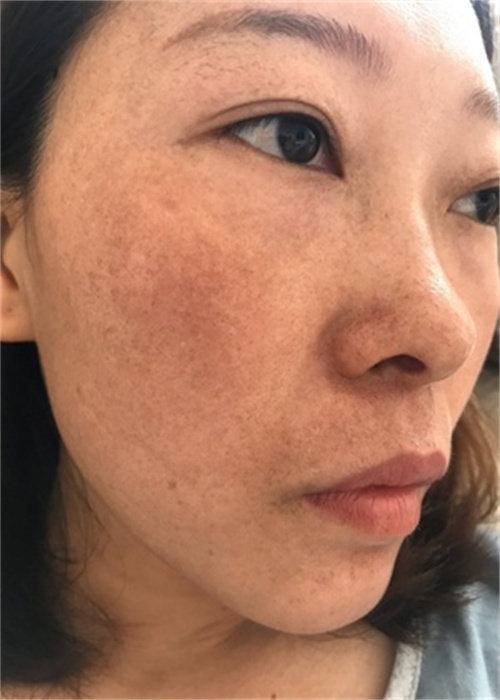 用着这款祛斑霜脸上的斑真的能淡化,没之前那么明显了,皮肤也变白皙不