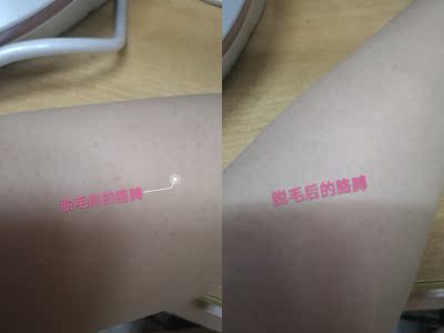 说说博朗脱毛仪BD3003怎么样，脱毛效果真的有那么好吗？夸张？
