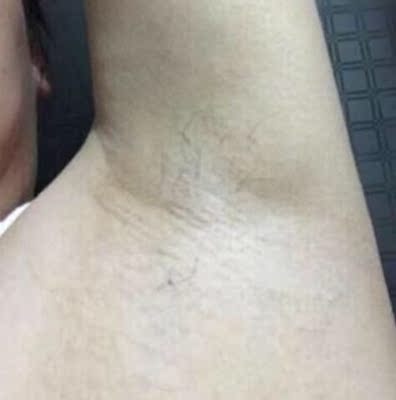 一直都是腋下很黑，不敢穿吊带。最近逛淘宝看到这个产品，就寻思着买回来试试，效果不错哟，才用了几天，就明显感觉白了不少。先把腋下美白回来，再试试其他地方。